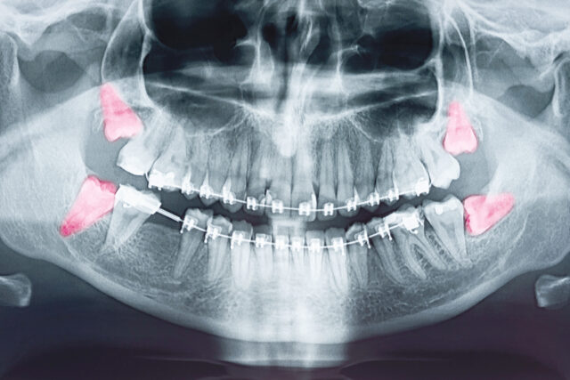 Dente Del Giudizio Centri Medici Primo